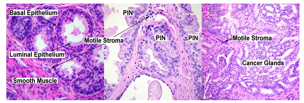 Three different types of prostate cancer progression